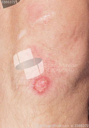 Image of wound