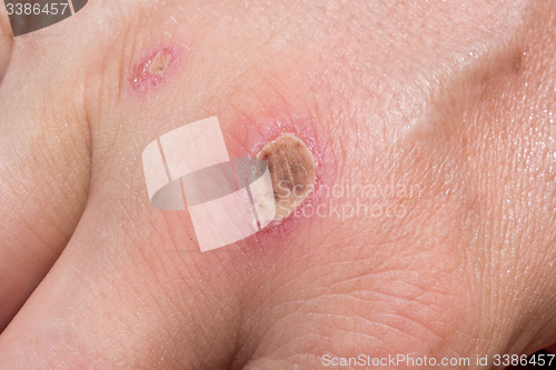 Image of wound