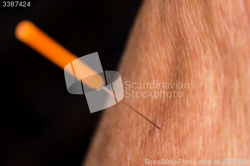 Image of acupuncture treatment on leg