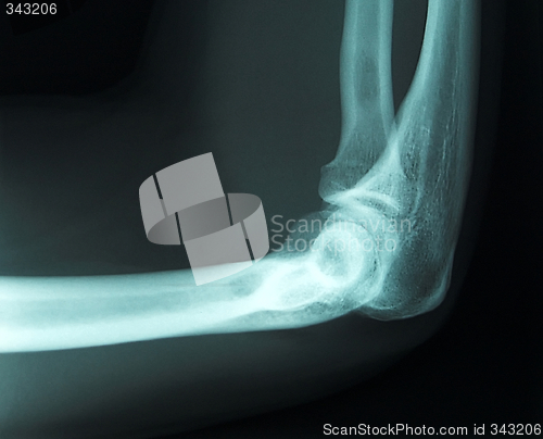 Image of x-ray of a male arm