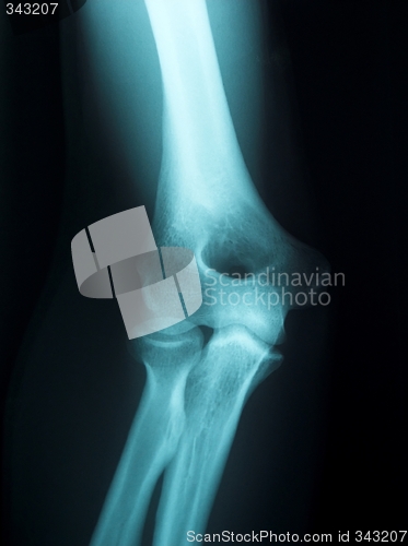 Image of x-ray of a male arm