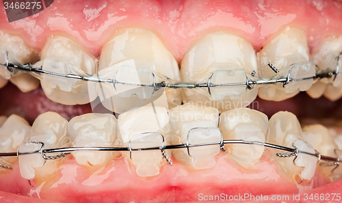 Image of Braces