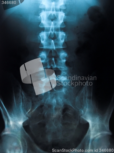 Image of x-ray of a young male spine