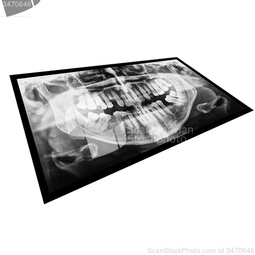 Image of Black and white Medical Xray of teeth