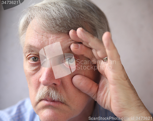 Image of bloodshot eyes in a senior man 