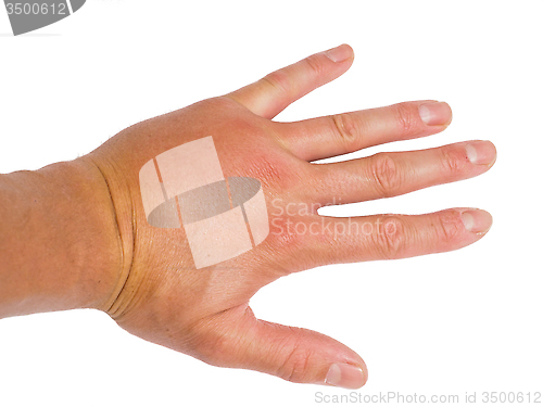 Image of Male person showing swollen knuckles on left hand isolated on wh