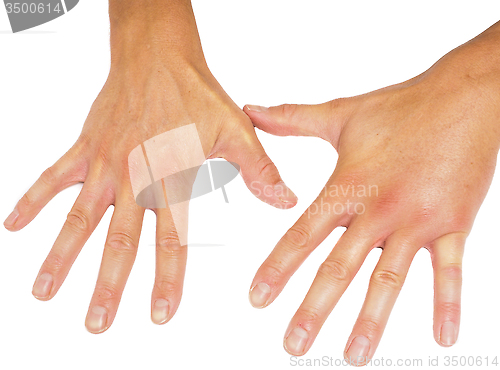 Image of Comparing swollen male hands isolated towards white background