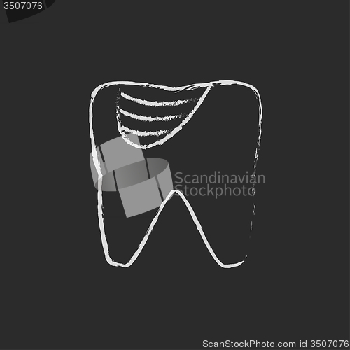 Image of Tooth decay icon drawn in chalk.