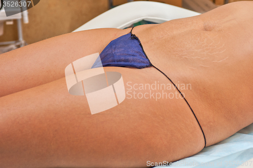 Image of procedure