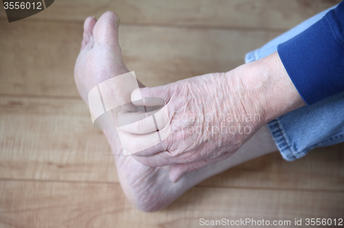Image of man with rash on foot