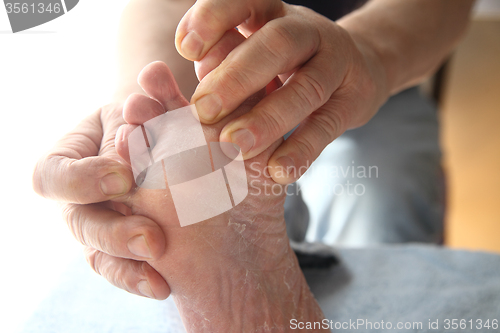 Image of Foot with dry, peeling skin