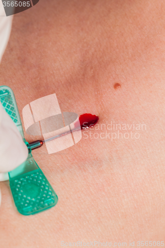 Image of Subcutaneous medical injection concept