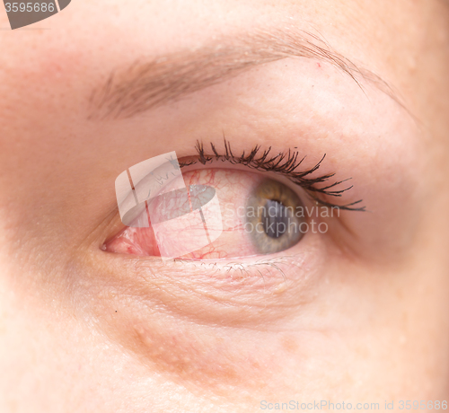 Image of irritated eye