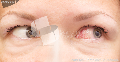 Image of healthy and irritated eye