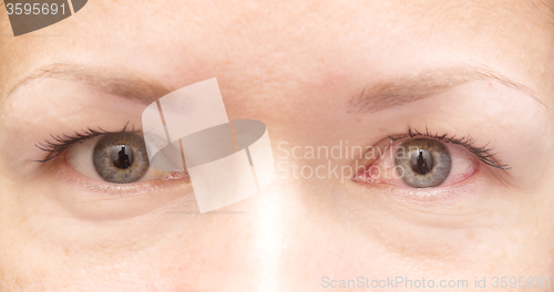 Image of healthy and irritated eye