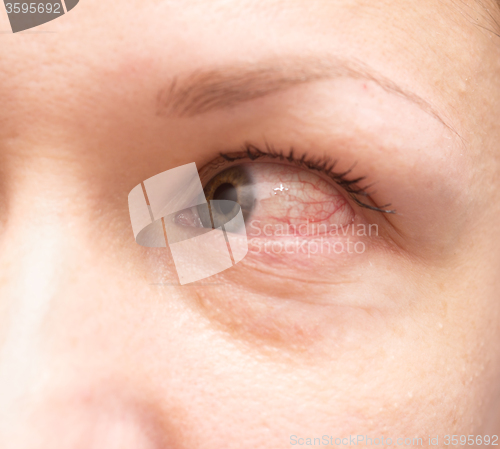 Image of irritated eye