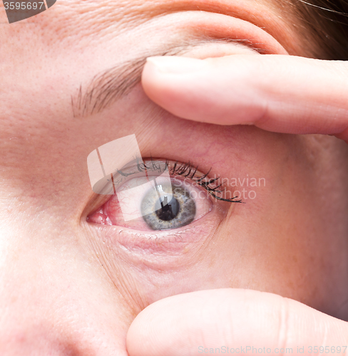 Image of irritated eye