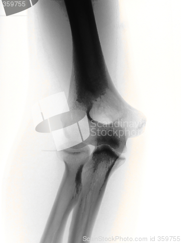 Image of x-ray of a elbow