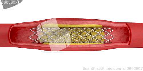 Image of Angioplasty with stent placement