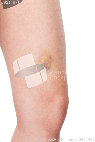 Image of Woman nursing an injured bruised grazed knee 