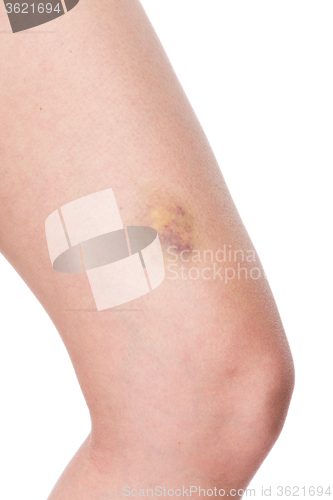 Image of Bruised knee