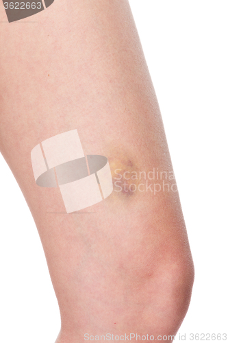 Image of Woman with sore leg