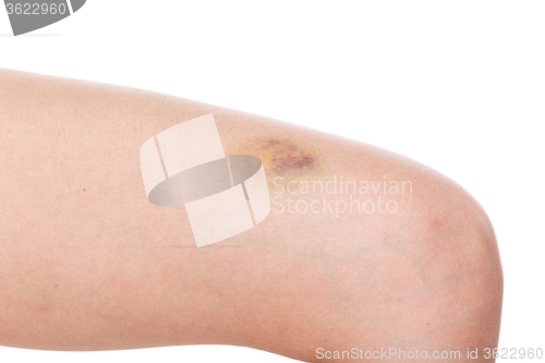 Image of Woman leg with pain and a large bruise