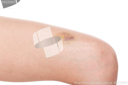 Image of Woman leg with pain and a large bruise