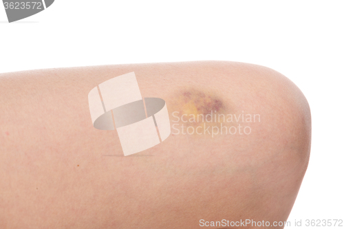 Image of Bruise on wounded woman leg skin