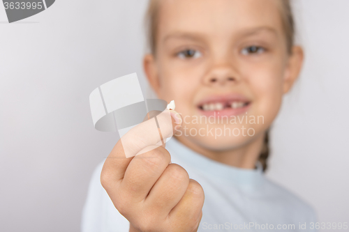 Image of Six year old girl showing her fallen front upper teeth