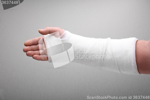 Image of broken arm bone in cast 