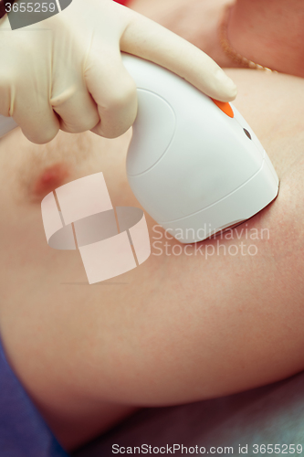 Image of male laser epilation