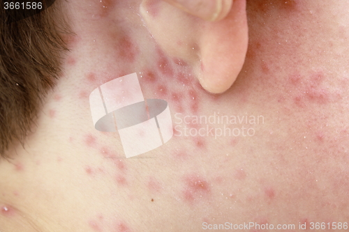 Image of detail of chicken pox effects