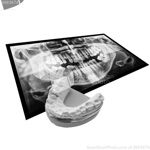 Image of Black and white Xray of teeth with positive teeth cast