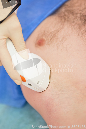 Image of male laser epilation