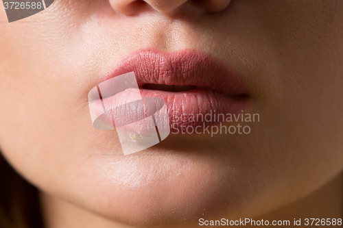 Image of beautiful lips virus infected herpes