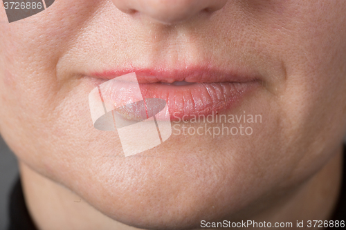 Image of Lip infection with the herpes virus