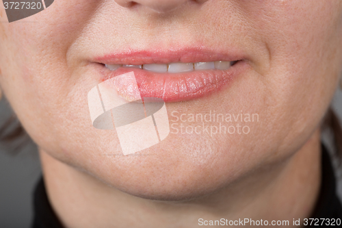 Image of Lip infection with the herpes virus