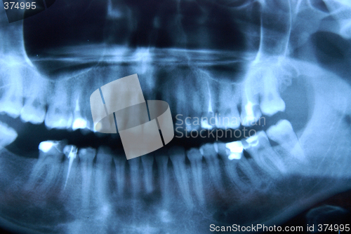 Image of roentgen - jaw, nandible