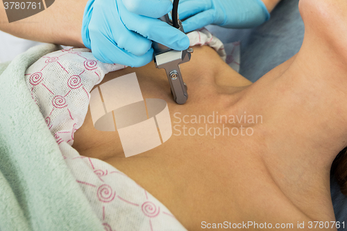 Image of fractional laser rejuvenation