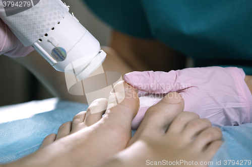 Image of Podiatrist treating onychomycosis with a laser