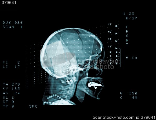 Image of skull cat scan