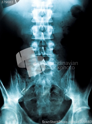 Image of x-ray of a young male spine