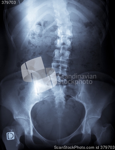 Image of x-ray of a young female spine