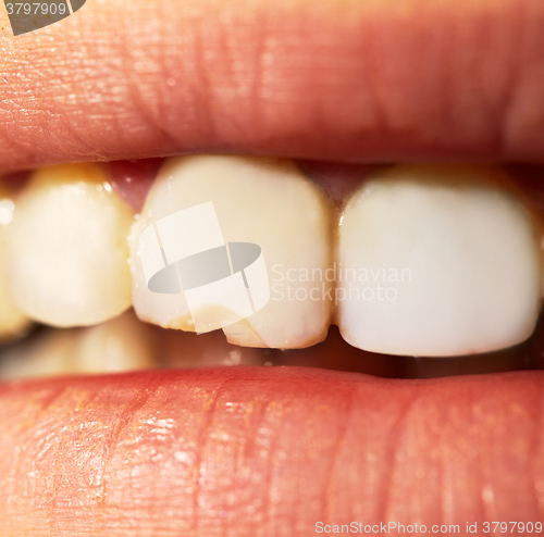 Image of Macro shot of the broken tooth.