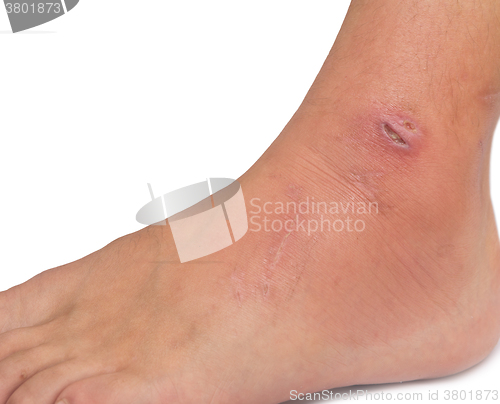 Image of wound on foot