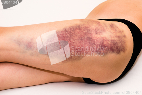 Image of Bruise on wounded woman leg