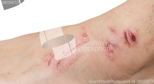 Image of wound on a foot