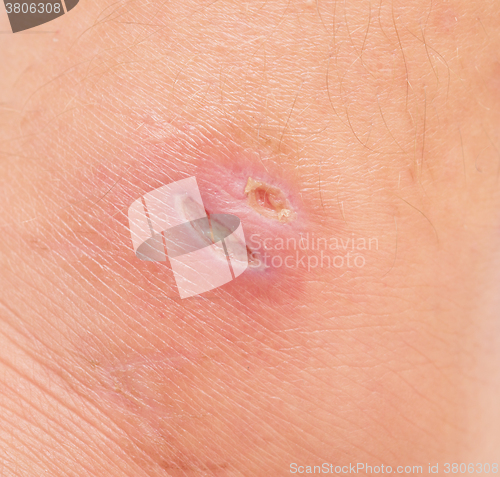 Image of wound