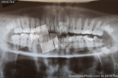 Image of Radiograph teeth